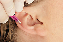 Awwendung von Templax Nadeln zur Ohrakupunktur